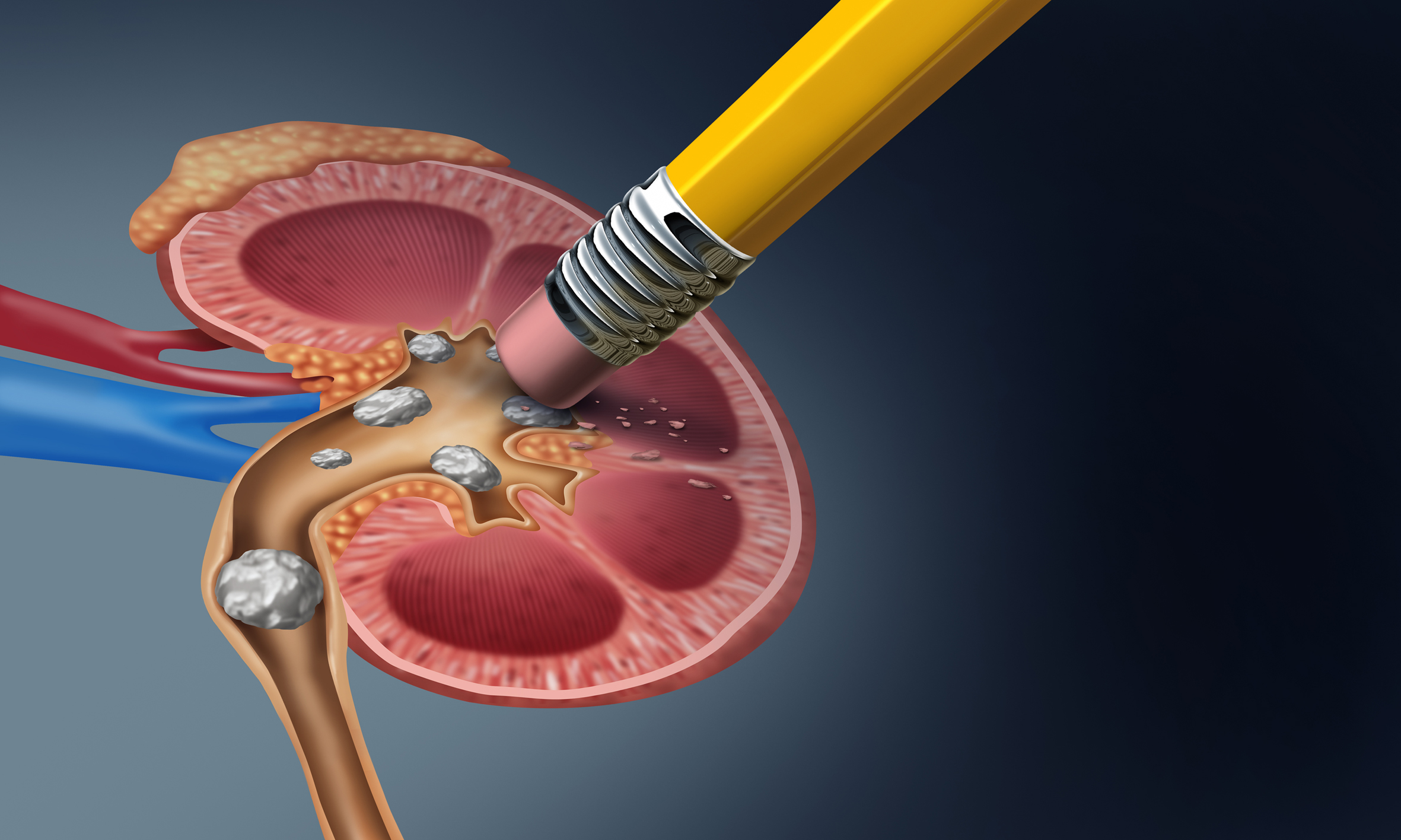 how long does it take to pass a kidney stone