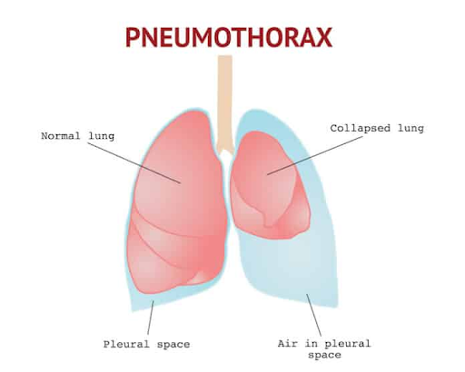 pneumothorax